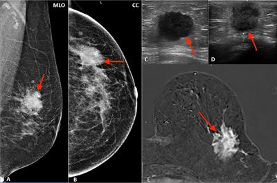 Frontiers | Multimodality Imaging In Lobular Breast Cancer: Differences ...